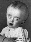 Hydrocephalus-2.jpg