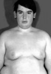 Gynecomastia01-208x300.jpg